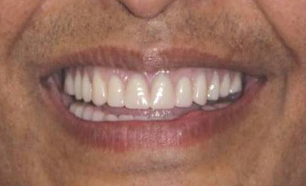1-after-dental-implants-11229 1-after-dental-implants-11229