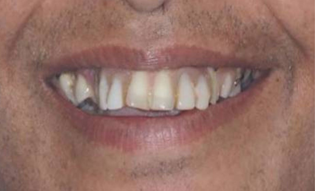 1-before-dental-implants-11229 1-before-dental-implants-11229