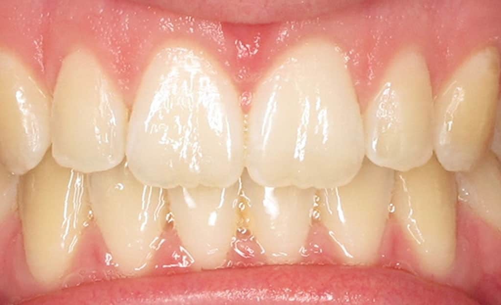 2-after-dental-implants-11229 2-after-dental-implants-11229