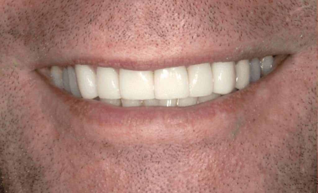 3-after-dental-implants-11229 3-after-dental-implants-11229