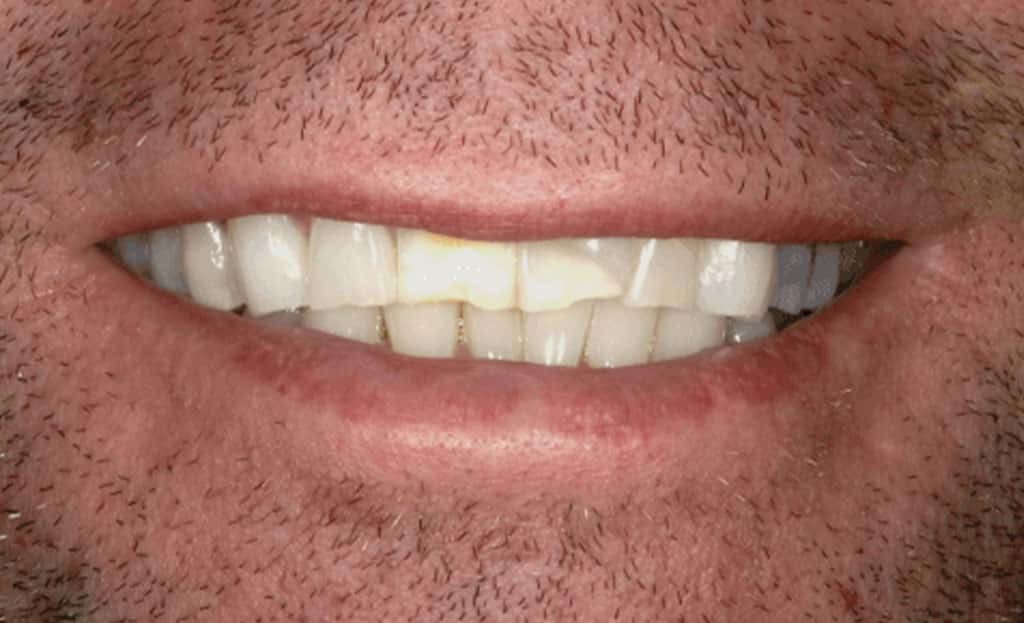 3-before-dental-implants-11229 3-before-dental-implants-11229