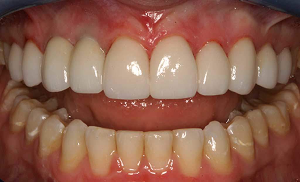 4-after-dental-implants-11229 4-after-dental-implants-11229