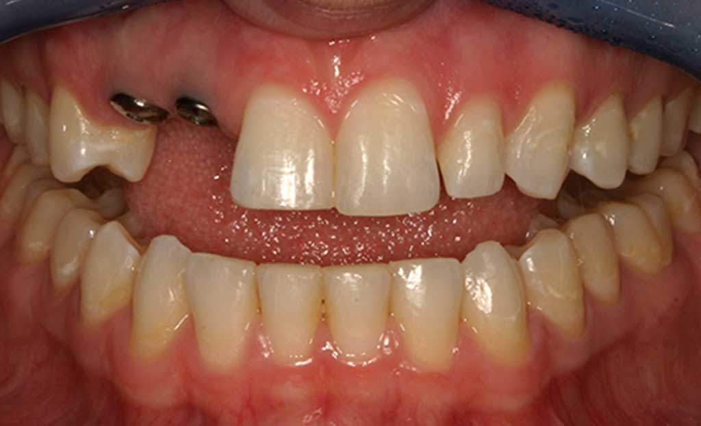 4-before-dental-implants-11229 4-before-dental-implants-11229