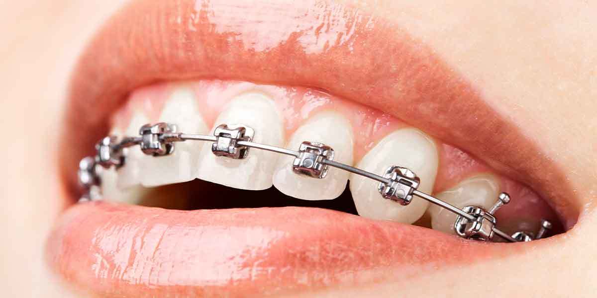 Dental Braces