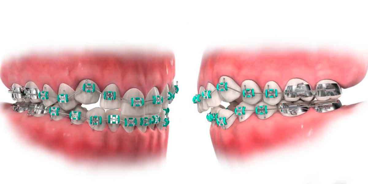 Dental Braces