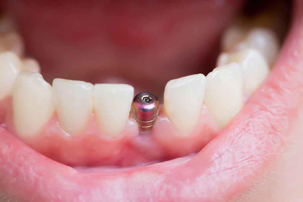 Dental Implants