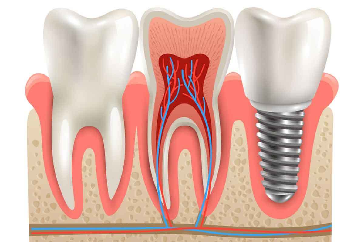 Dental Implants