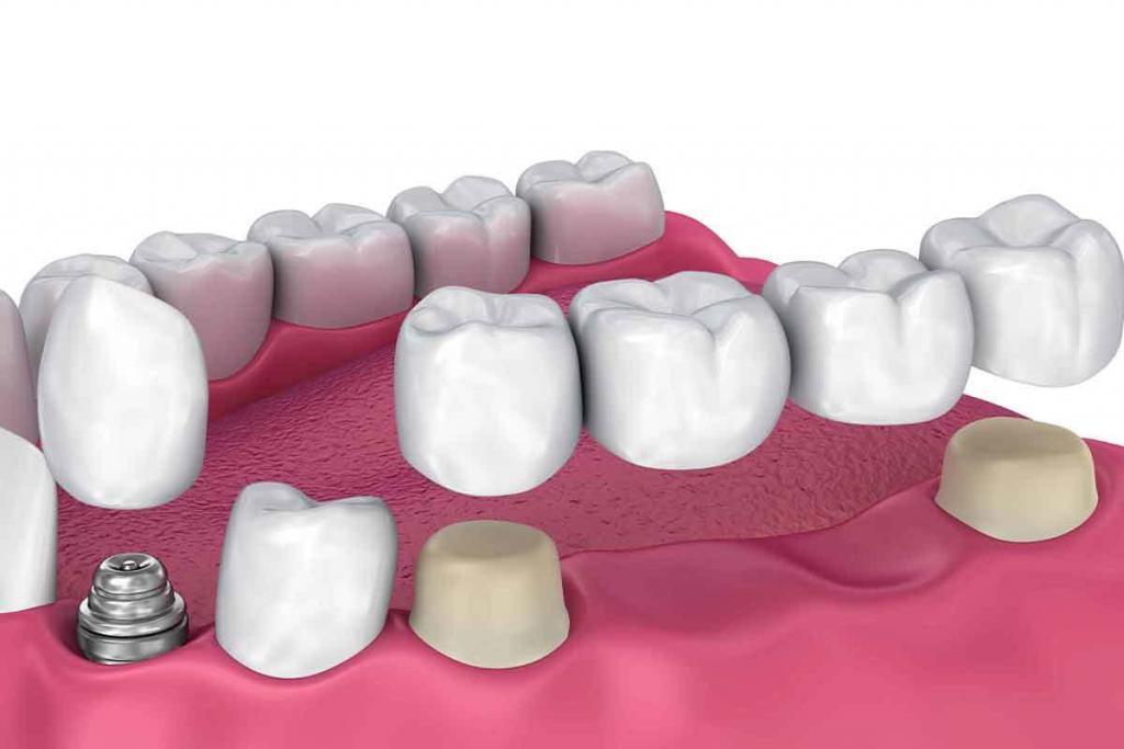 Dental Implant and dental bridge