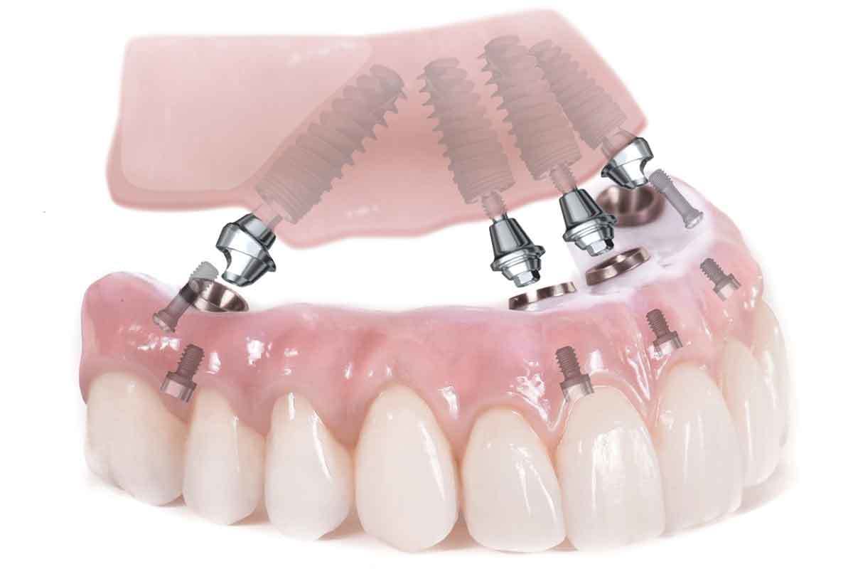 Dental Implants