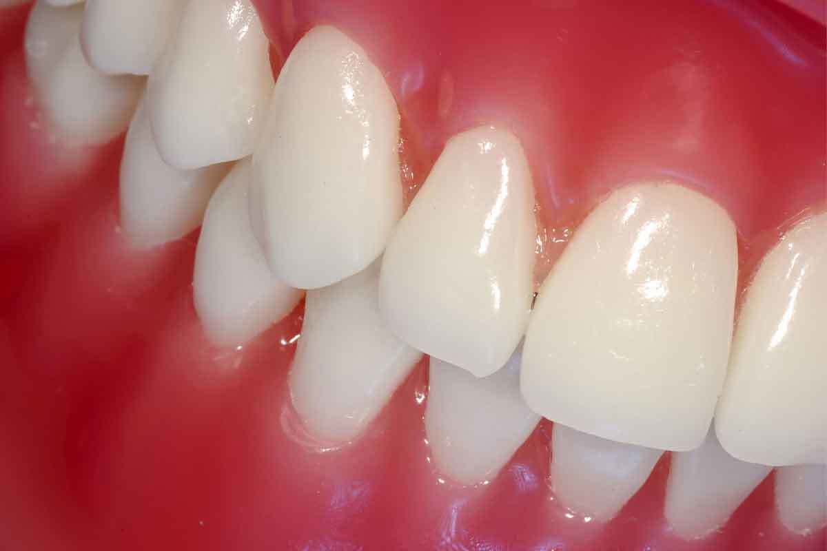 One-Visit Dental Crown?