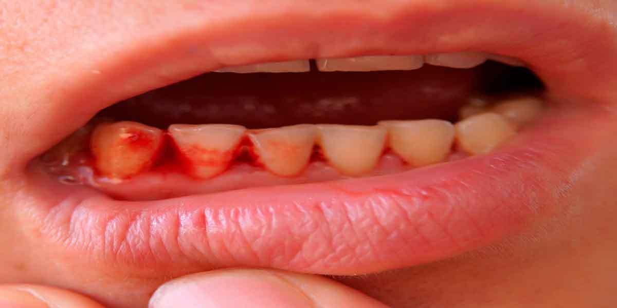 Periodontal Disease