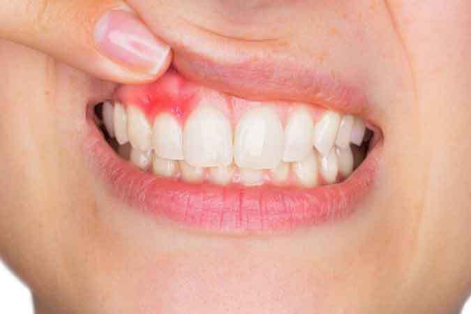 Periodontal Disease