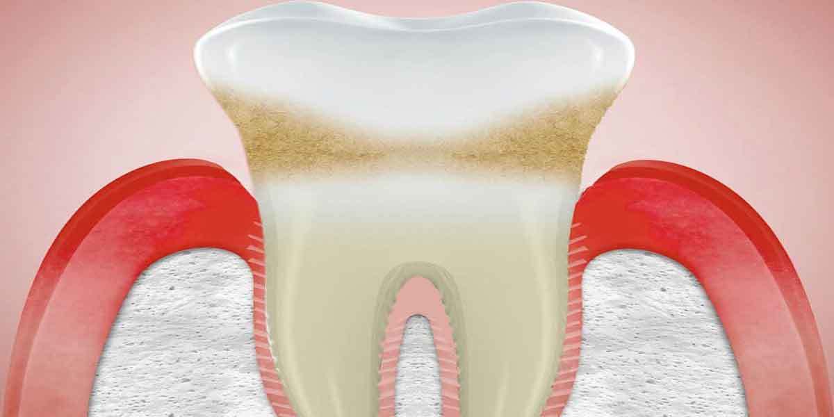 Periodontal Disease