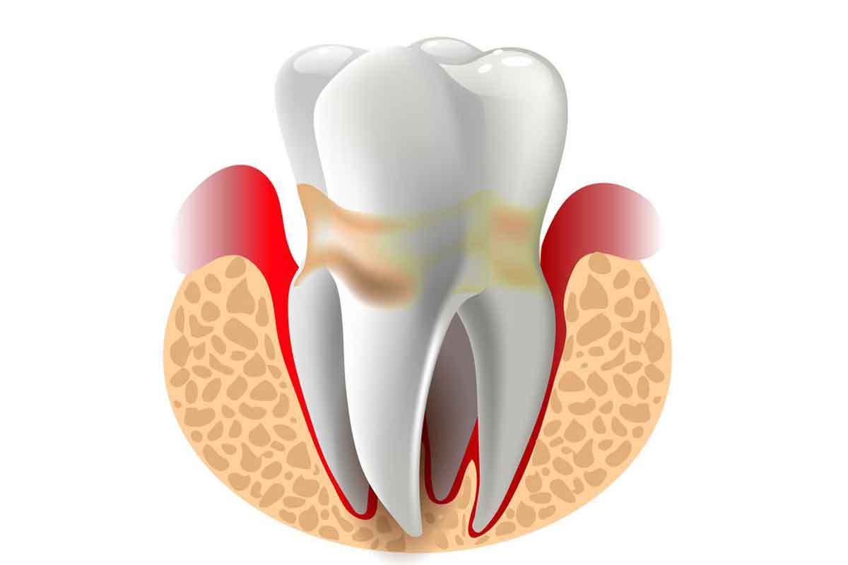 Periodontal Disease Help