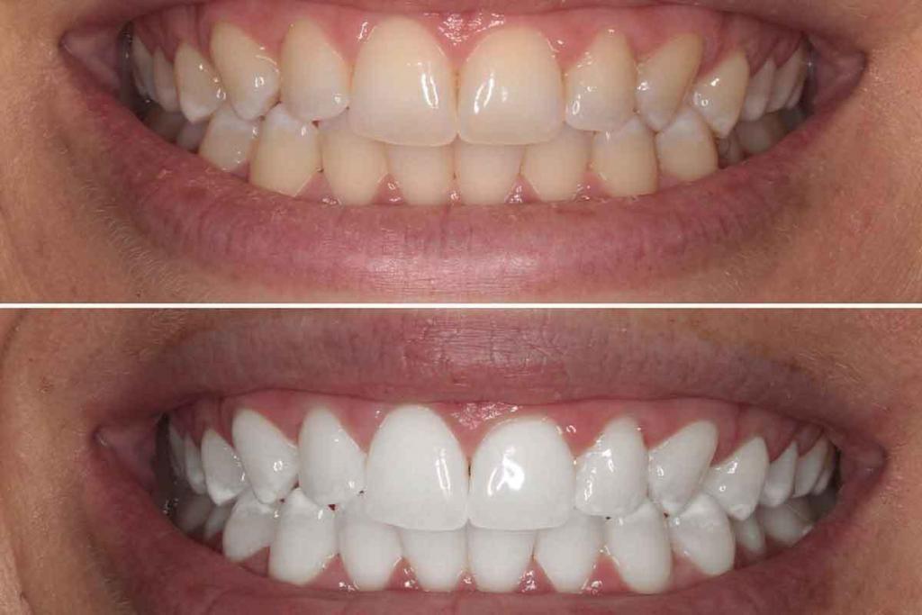 Professional Teeth Whitening