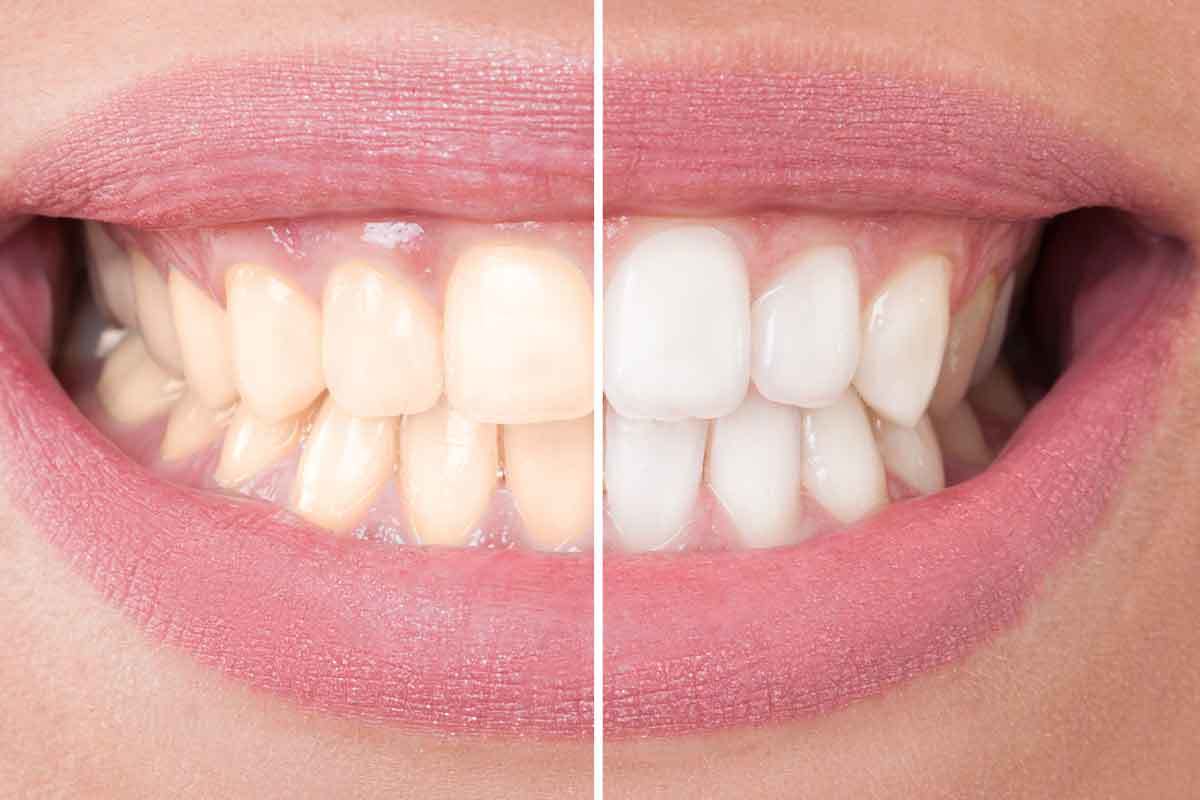 Teeth Whitening