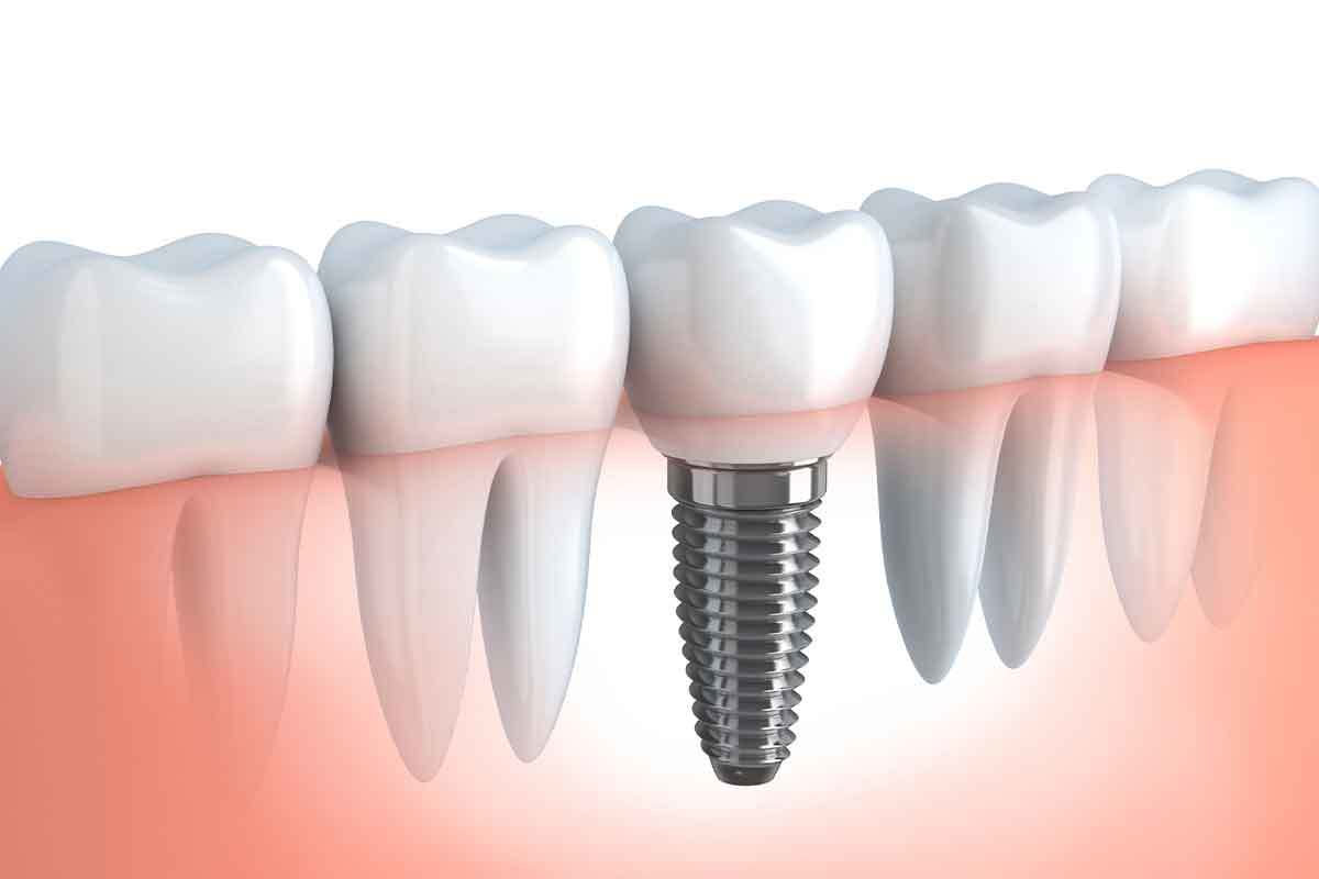 Dental implant