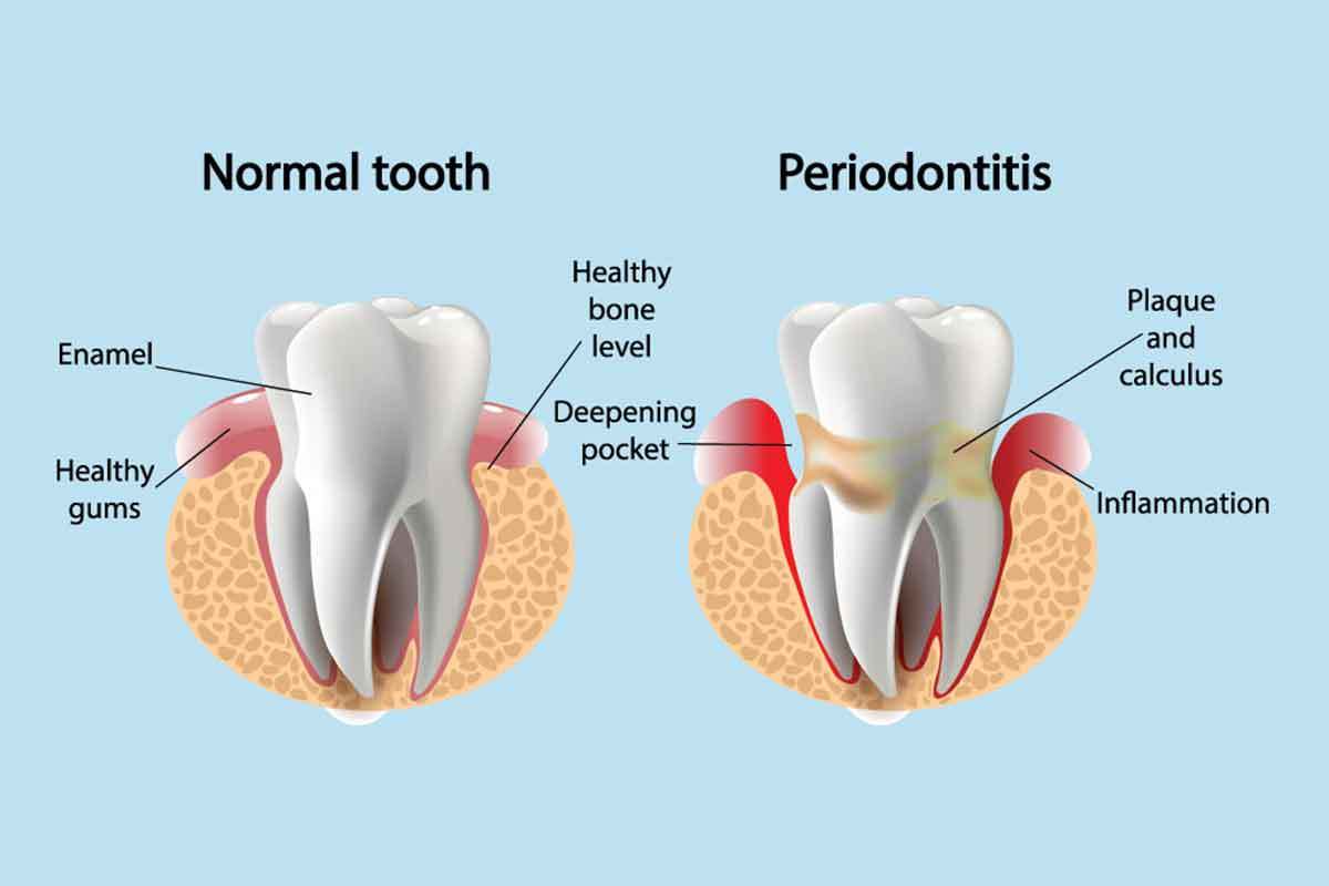 Periodontal Disease