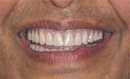 1-after-dental-implants-11229 Dental implants 11229