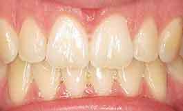 2-after-dental-implants-11229 Dentist Brooklyn 11229