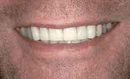 3-after-dental-implants-11229 dental implants in dental office 11229