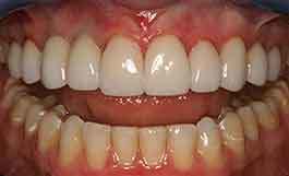 4-after-dental-implants-11229 dental implants in Brooklyn