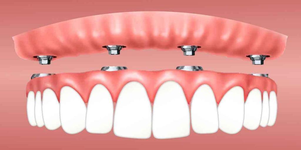 Dental Implants vs. Dental Bridges