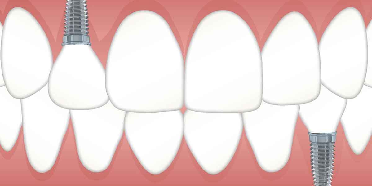 Dental Implants – Procedure and Benefits
